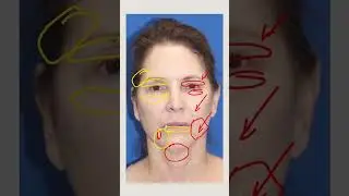 Анализ лица перед подтяжкой лица! Планирование вертикальной восстановительной подтяжки лица!