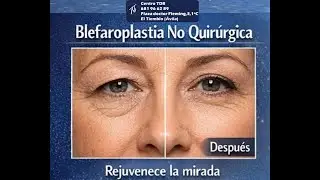 REALZA TU MIRADA EN EL CENTRO TDB CON BLEFAROPLASTIA SIN CIRUG&Iacute;A
