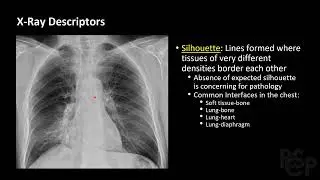 How to Read a Chest Xray - Approach to Chest X Ray - RSCP Video Curriculum
