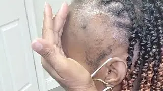 Tutorial | Thin Edges| Alopecia Cover-Up  Using Faux Locs | Ms. Pk's