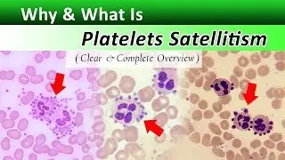 What is Platelets Satellitism  ?  ( Increase Your Identification Skills )