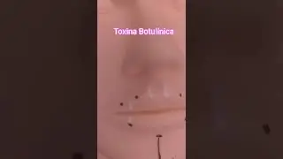 Como aplicar toxina Botul&iacute;nica #botox #toxinabotulinica