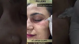 Woman With Dark Circles Get Under-Eye Filler Injections For The First Time | AwishClinic.com #shorts