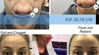 #TransformationThursday #HydraFacialNation