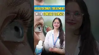 Can Contact Lenses Manage Keratoconus? | Best Lens Options Explained
