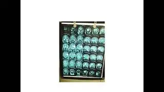 MRI Brain: Learn interpretation of brain MRI in 1 Day