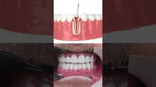 Root Canal Treatment Explained | Step-by-Step Dental Procedure & Real Results in Turkey