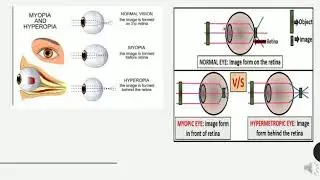 Disorders Of Eye