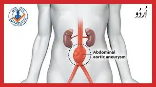 Abdominal Aortic Aneurysm Explained in urdu