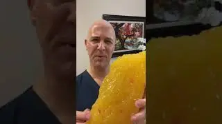 Can This Really Be 5 Pounds of Fat? 😒  Dr. Mandell