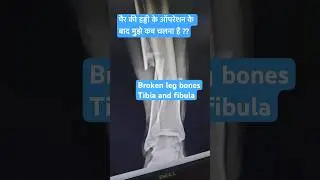 #fracture #recoveryjourney #painrelief #pain #doctor #physiotherapy #motivation