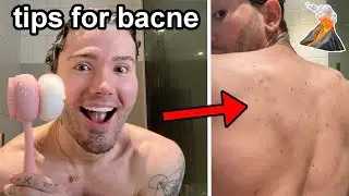 5 TIPS FOR PEOPLE WITH BODY ACNE!🌋 (how I got rid of mine in a few weeks) AD