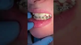 Can I have braces and clear aligners at the same time? Hybrid Orthodontic therapy - Tooth Time