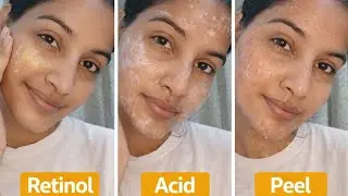 &ldquo;Retinol, Acid, Peel &ndash; Ye Galti Kar Li To Skin Barbaad Ho Jayegi | Brutally Honest&rdquo;