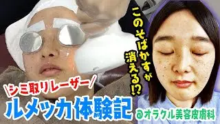 【ルメッカ】世界最新シミ取りレーザーでそばかす抹消チャレンジしてきた！