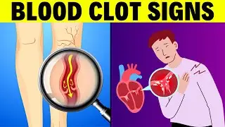 8 Blood Clot Warning Signs | Be Aware of These