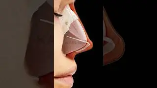 Droopy tip and its correction ⭕️ KAMINSKYI