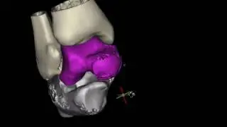 Ankle - Post Op Calcaneal fracture 3D