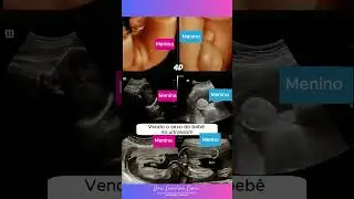 Consegue identificar o sexo do beb&ecirc; no ultrassom?