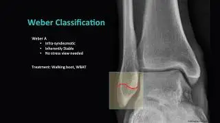 Distal Fibula Fractures