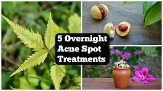 5 Overnight Acne Spot Treatments That Will Vanish Pimples Overnight !
