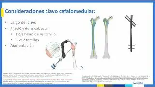 Fracturas de Cadera Pertrocant&eacute;ricas y Subtrocant&eacute;rica  Seminarios Ortopedia y Traumatolog&iacute;a UC 2024