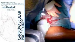 Left Iliofemoral DVT Thrombectomy Using ClotTriever Device (Rahimi, MD, Rojo, MD, Mohamed, MD)
