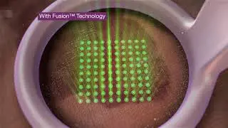 Introducing the NEW PicoWay&reg; Resolve Fusion 532 nm handpiece | Spectra Medical