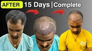 Happy Patient |15 Days Complete | After Hair Transplant | India 2024 | Divine Cosmetic Clinic