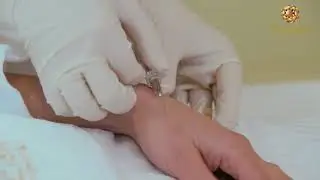 Restylane Vital Руки