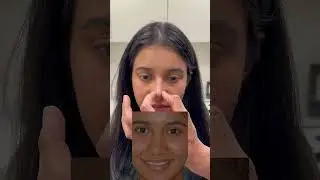 3 month rhinoplasty result | Anthony Bared MD, FACS | Miami, FL