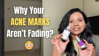 Best Nykaa Routine for Acne Marks (Scientifically Explained) - Glycolic Acid + Kojic Acid
