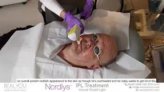 Male client receives IPL (Intense Pulsed Light) Nordlys treatment for rosacea, outstanding results