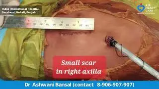 Heart Hole Surgery (VSD) without cutting any bone | Hidden scar in right axilla | Fast recovery