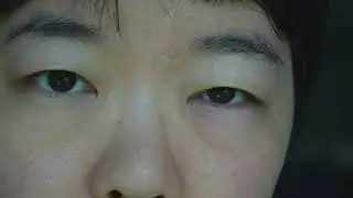 Understanding Eye Health Through Traditional Chinese Medicine |Eye Disorders 👁️ | Acupuncture & Herb