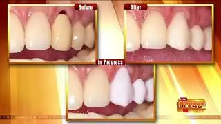 Get New Dental Crowns in Just an Hour
