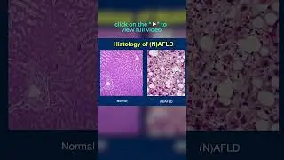 How come children are ending up with Non alcoholic fatty liver disease?