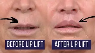 Los Angeles Upper Lip Lift | Beverly Hills Lip Augmentation Plastic Surgeon Dr. Ben Talei