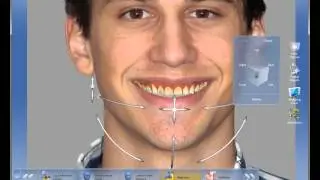Enhance Smiles Seamlessly: CEREC Software 4.2 Smile Design