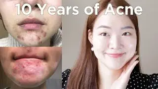the best skincare for acne (no ad)