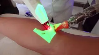 LASER PARA TRATAMENTO DE VASINHOS E VARIZES