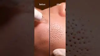 Gentle Forehead Pore Cleaning | Realistic ASMR 124