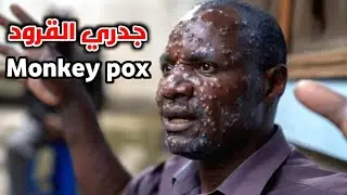 ماهو مرض جدري القرود؟ (monkeypox virus)