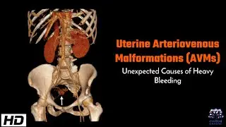Uterine Arteriovenous Malformations (AVMs): Unexpected Causes of Every Bleeding