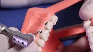 Preparación y técnica para la realización de cavidades clase V