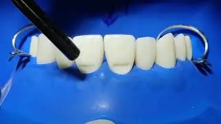Class V tooth colored restorations