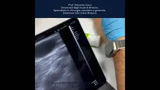 Scleroterapia ecoguidata di varici