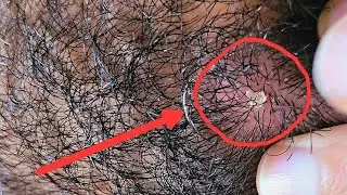 Beard Dandruff- Peeling off a tough dandruff patch in beard