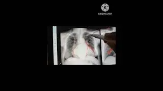 Left atrial enlargement( double density sign),Chest X ray ,part-1