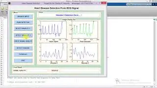 Heart Disease Detection from ECG Signal Using Matlab Project Code